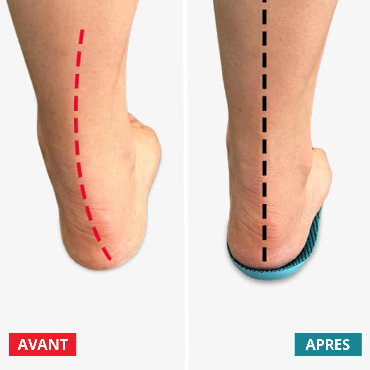 Semelles Teralym - Vivez des journées sans douleur, sans traitements coûteux ni visites chez le médecin...